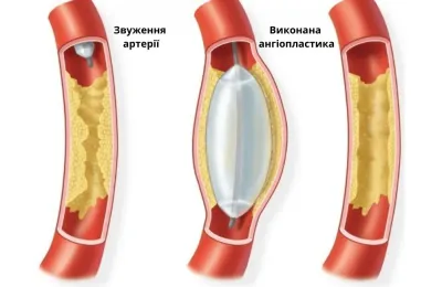 Балонна ангіопластика
