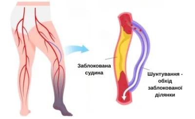 Шунтування
