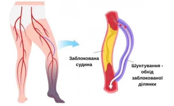 Шунтування артерії — обхід заблокованої ділянки судини