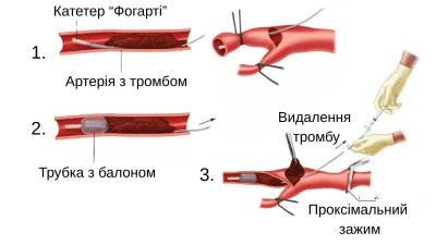 Тромбектомія