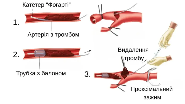 Етапи проведення тромбектомії